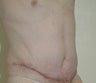 Abdominoplasty after weight loss