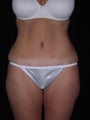 Tummy tuck