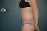 Tummy Tuck (Abdominoplasty)