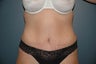 Tummy tuck after massive weight loss