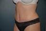 Tummy tuck after massive weight loss