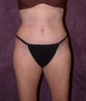 Tummy tuck (abdominoplasty) with liposuction of hips