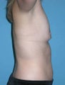 Abdominoplasty and Breast Augmentation
