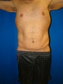 Male Tummy Tuck Surgery (abdominoplasty) Solana Beach, California