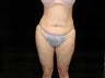 Abdominoplasty with Liposuction