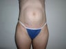 Abdominoplasty