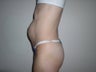 Abdominoplasty