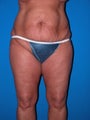 Tummy Tuck