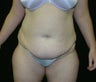 tummy-tuck with liposuction