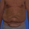 Abdominoplasty