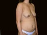Tummy Tuck