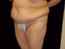 Abdominoplasty