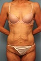 Tummy Tuck without muscle tightening