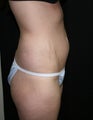 Abdominplasty (mini tummy tuck)