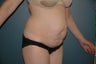 Tummy tuck