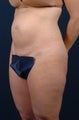 Abdominoplasty-Float