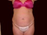 Tummy Tuck and Liposuction