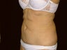 Tummy Tuck and Liposuction