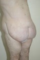 Abdominoplasty after weight loss