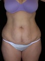 Tummy tuck