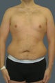 Male tummy tuck
