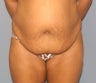 tummy tuck