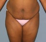 Tummy tuck