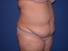 Tummy Tuck