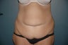 Tummy tuck after massive weight loss
