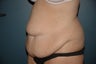 Tummy tuck after massive weight loss
