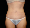 Standard Abdominoplasty