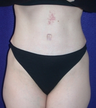 Tummy Tuck (abdominoplasty)