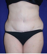 Tummy Tuck (abdominoplasty)