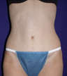 Tummy Tuck (abdominoplasty)