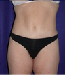 Tummy Tuck (abdominoplasty)