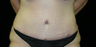 tummy tuck