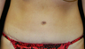 tummy tuck