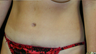tummy tuck