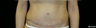 tummy tuck