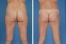 Liposuction and mini tummy tuck