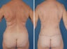 Flank Excision, Abdominoplasty Scar Revision, Liposuction of the Back