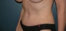 Tummy tuck