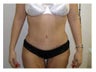 Tummy Tuck