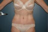 Tummy tuck