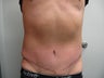 Abdominoplasty on 42 Year Old Male