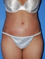 Abdominoplasty
