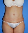 Abdominoplasty and liposuction of sides