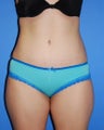 Abdominoplasty