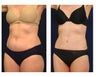 Abdominoplasty