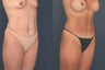 Full Tummy Tuck